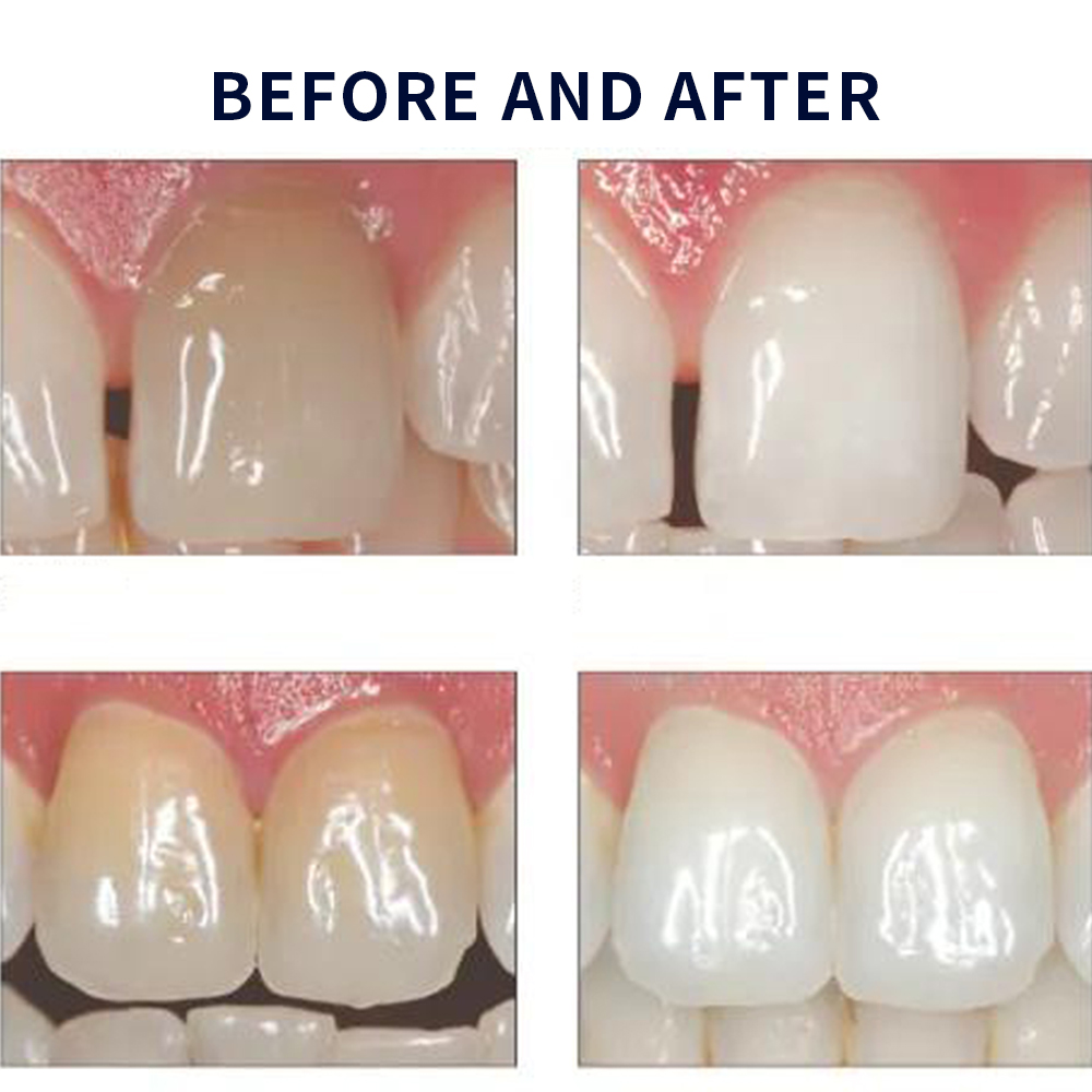 Opalescence Whitening 20% PF 2 - Teeth Whitening Gel recensione e prezzo