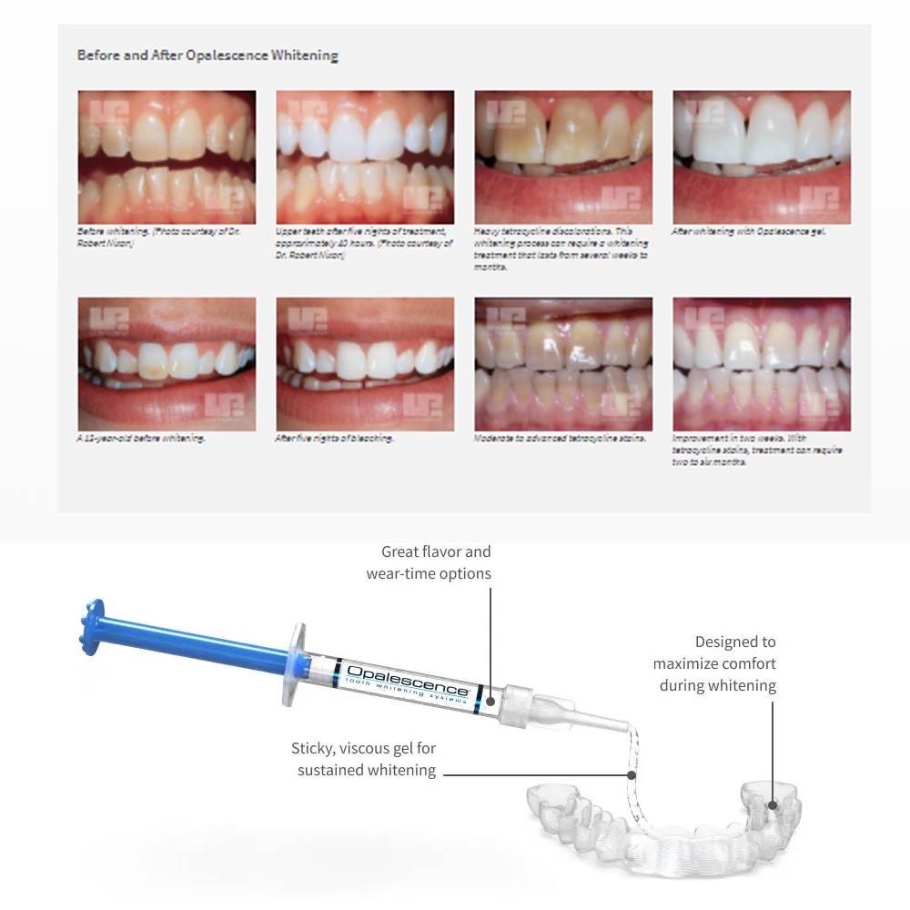 Opalescence Whitening 20% PF 2 - Teeth Whitening Gel recensione e prezzo