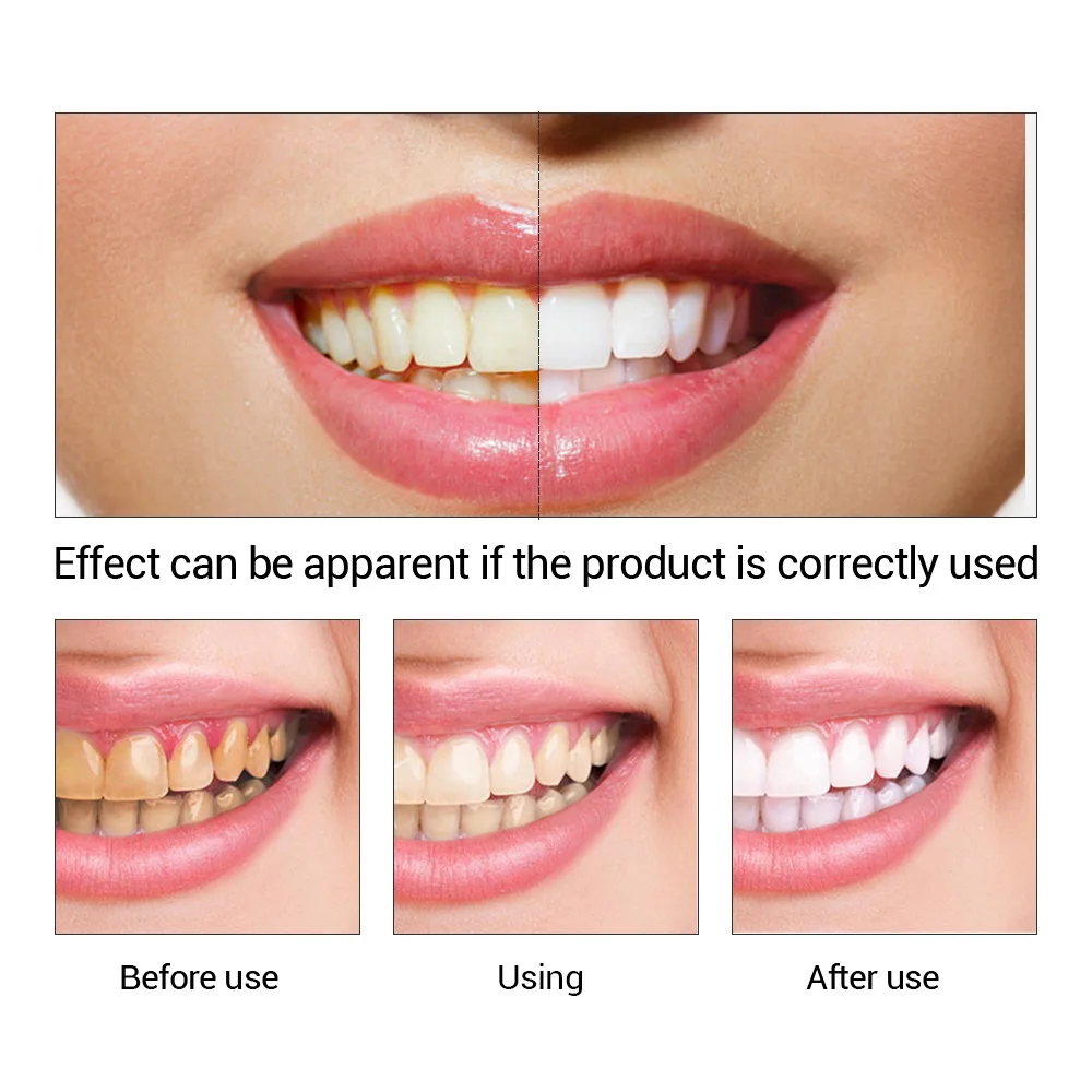 FTEENPLY Sbiancamento Dei Dent - Teeth Whitening Natural recensione e prezzo
