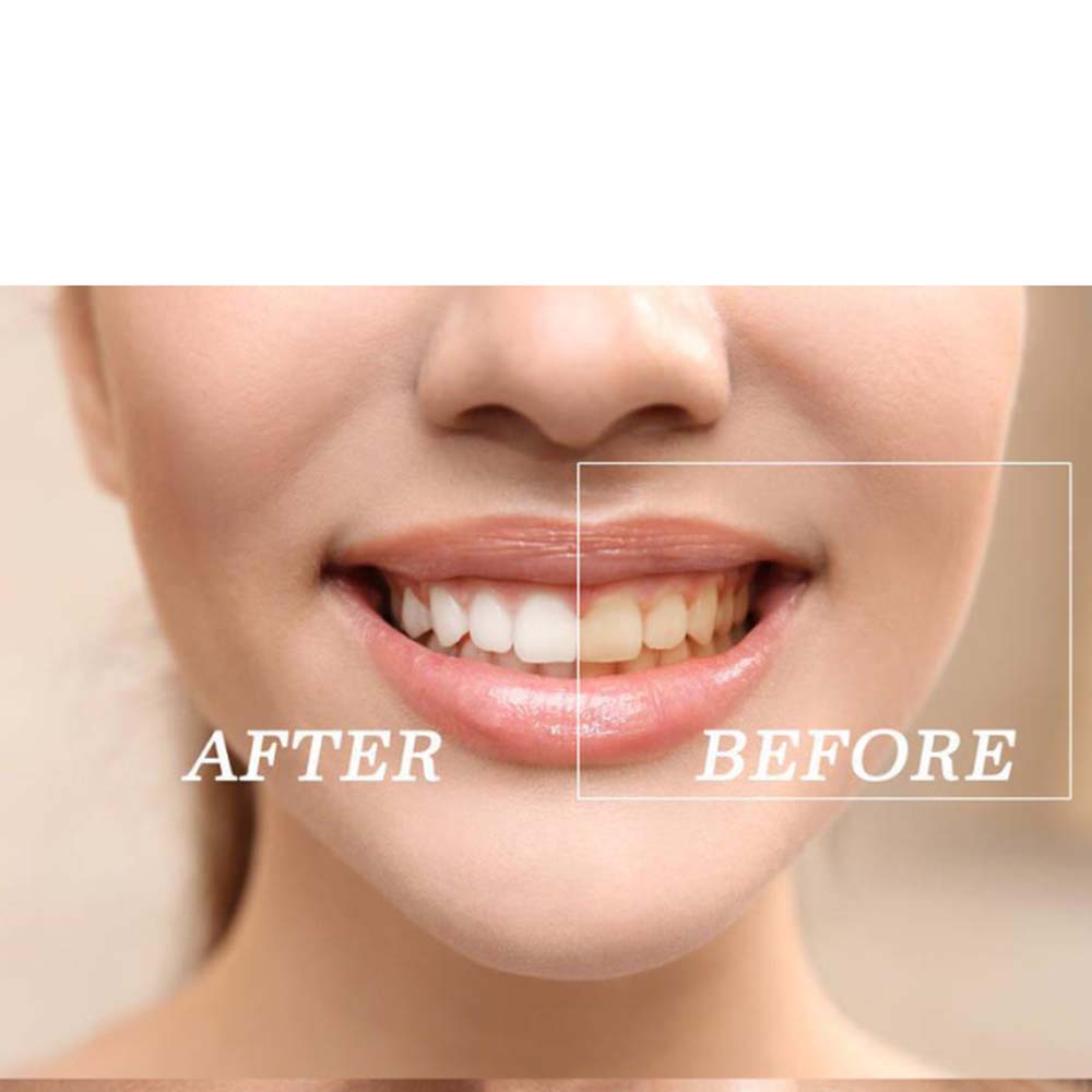 Kit gel sbiancante per denti c - Teeth Whitening Light Kit recensione e prezzo